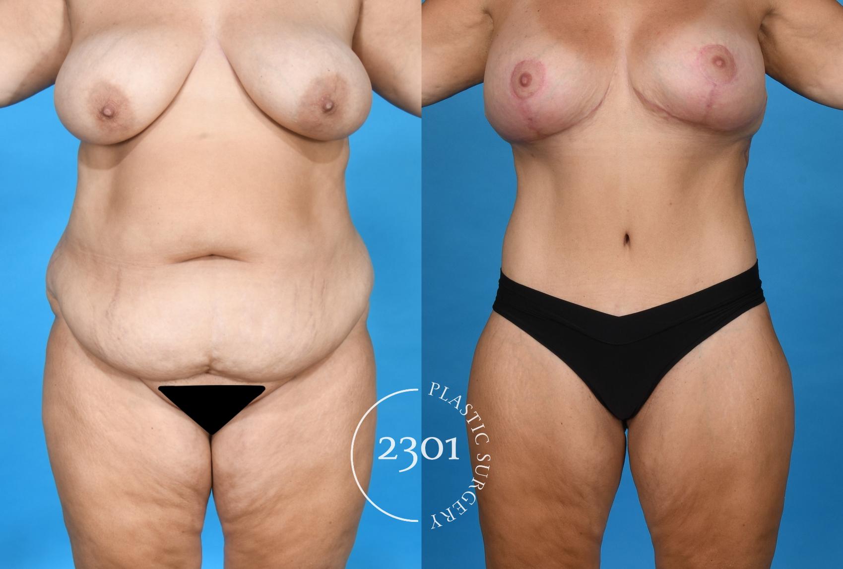 Before & After Liposuction Case 749 Front View in Fort Worth, Plano, & Frisco, Texas