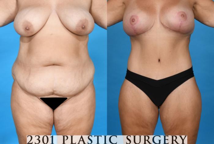 Before & After Liposuction Case 749 Front View in Fort Worth & Frisco, Texas