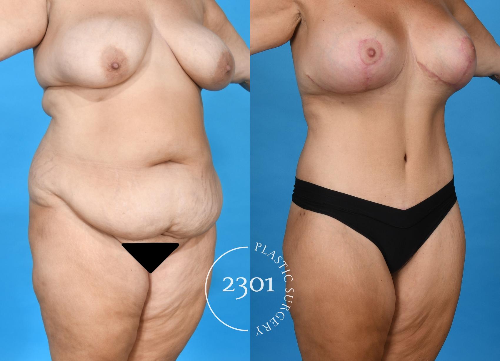 Before & After Mommy Makeover Case 749 Right Oblique View in Fort Worth, Plano, & Frisco, Texas