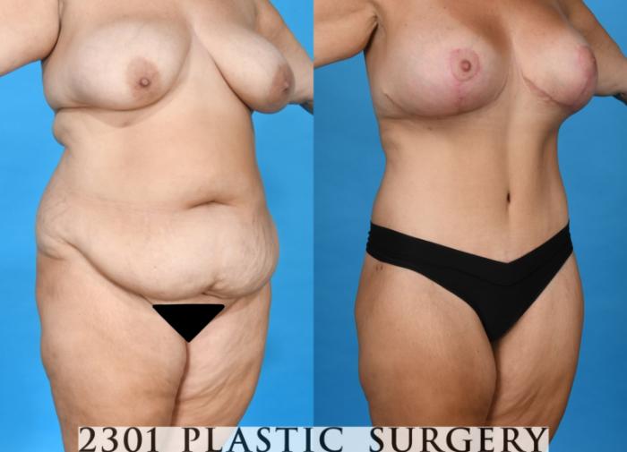 Before & After Liposuction Case 749 Right Oblique View in Fort Worth, Plano, & Frisco, Texas