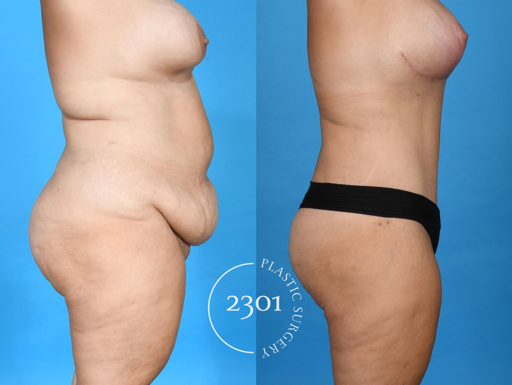Before & After Mommy Makeover Case 749 Right Side View in Fort Worth, Plano, & Frisco, Texas