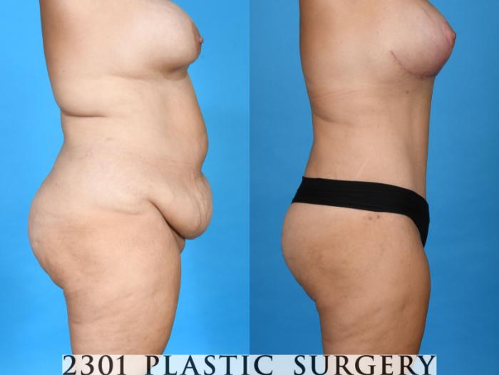 Before & After Post-Bariatric Plastic Surgery Case 749 Right Side View in Fort Worth, Plano, & Frisco, Texas