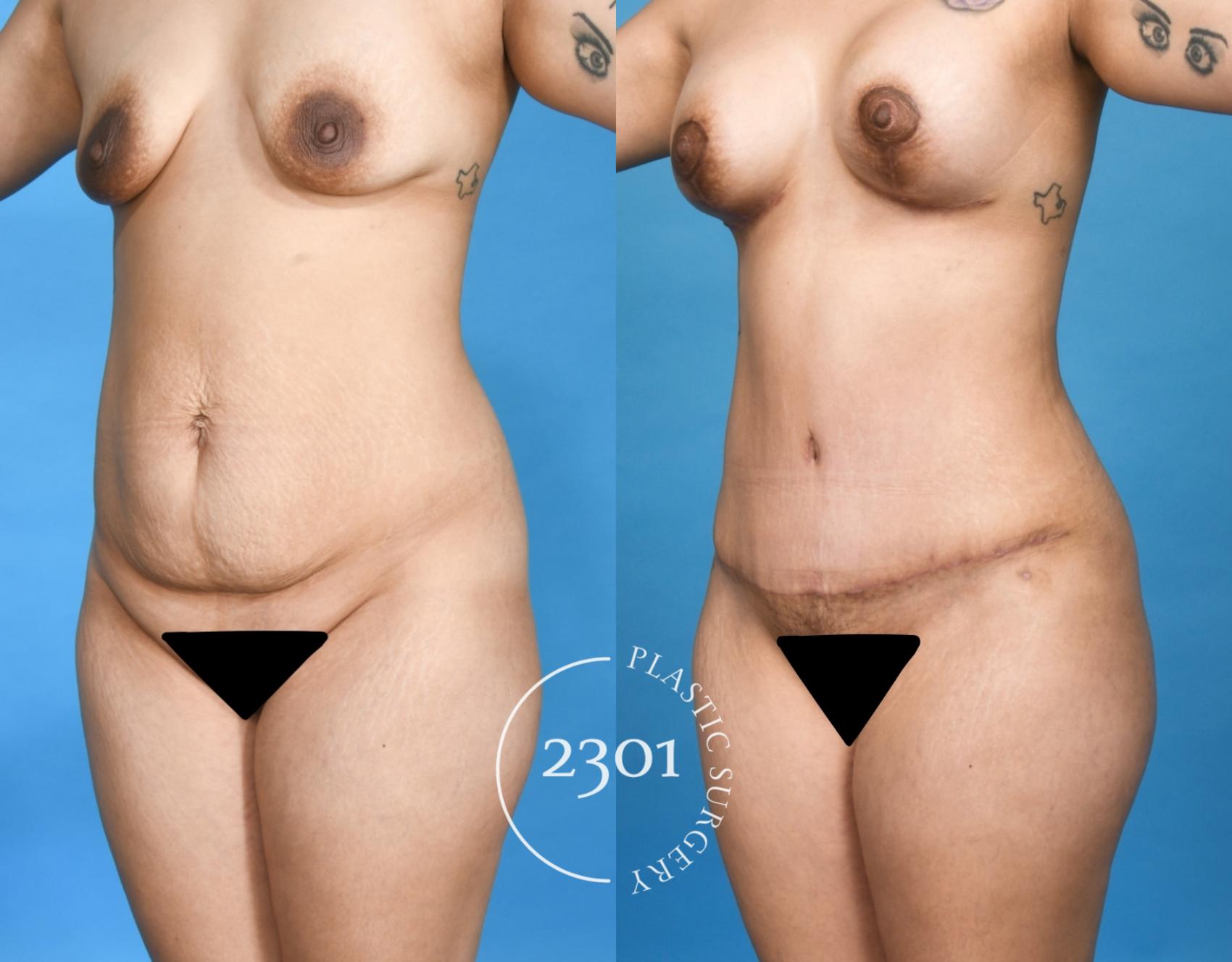 Before & After Mommy Makeover Case 750 Left Oblique View in Fort Worth, Plano, & Frisco, Texas