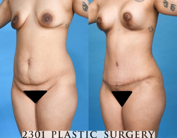 Before & After Tummy Tuck Case 750 Left Oblique View in Fort Worth, Plano, & Frisco, Texas