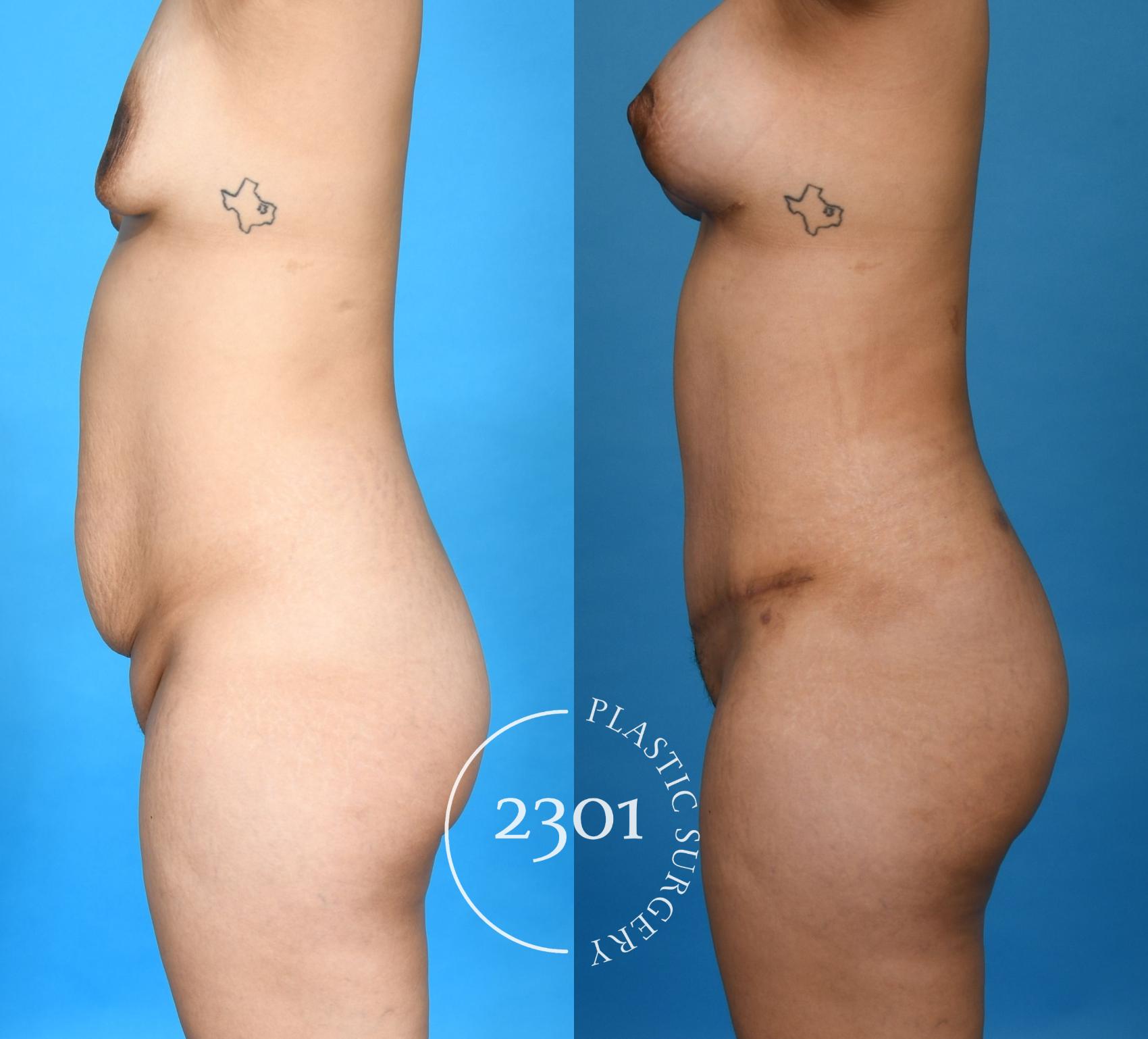 Before & After Mommy Makeover Case 750 Left Side View in Fort Worth, Plano, & Frisco, Texas