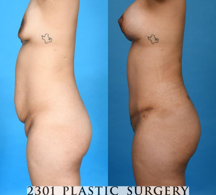 Before & After Mommy Makeover Case 750 Left Side View in Fort Worth, Plano, & Frisco, Texas