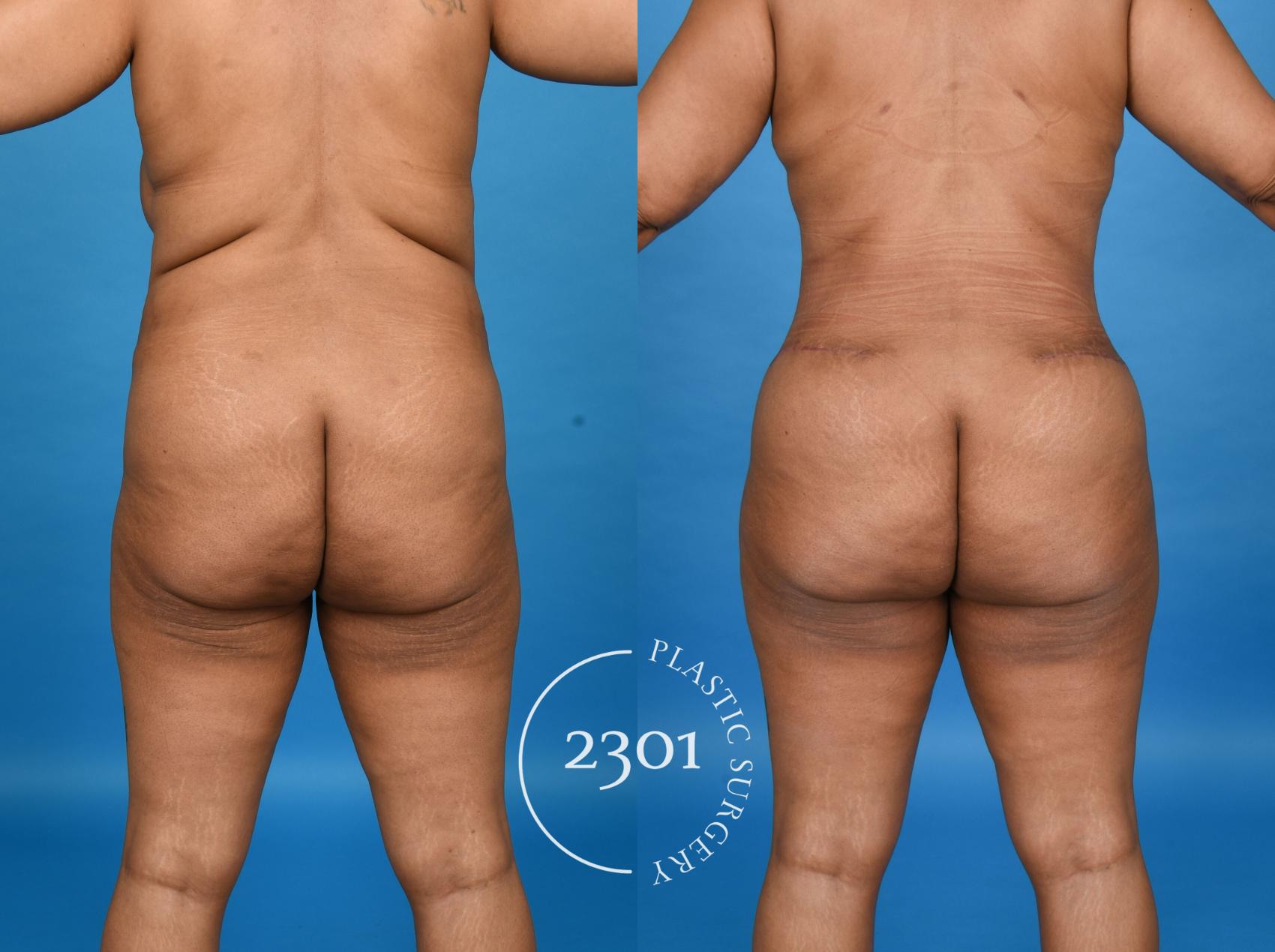 Before & After Mommy Makeover Case 758 Back View in Fort Worth, Plano, & Frisco, Texas