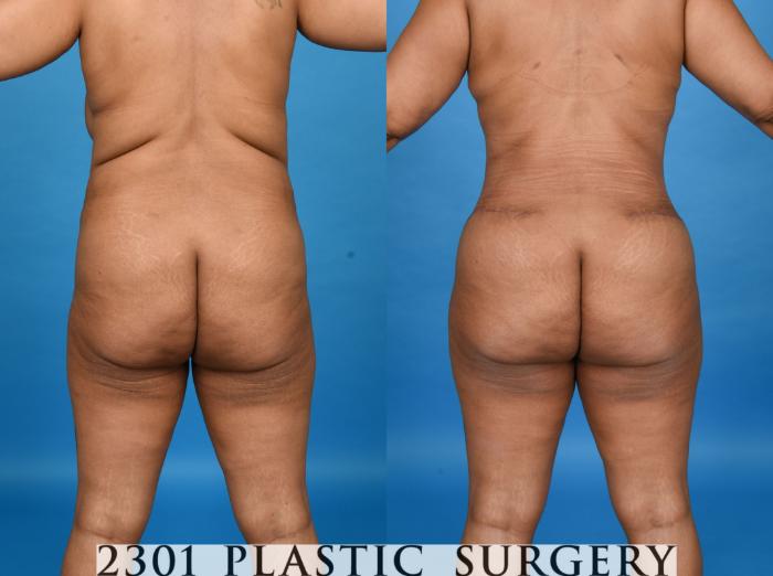 Before & After Tummy Tuck - Extended Case 758 Back View in Fort Worth, Plano, & Frisco, Texas