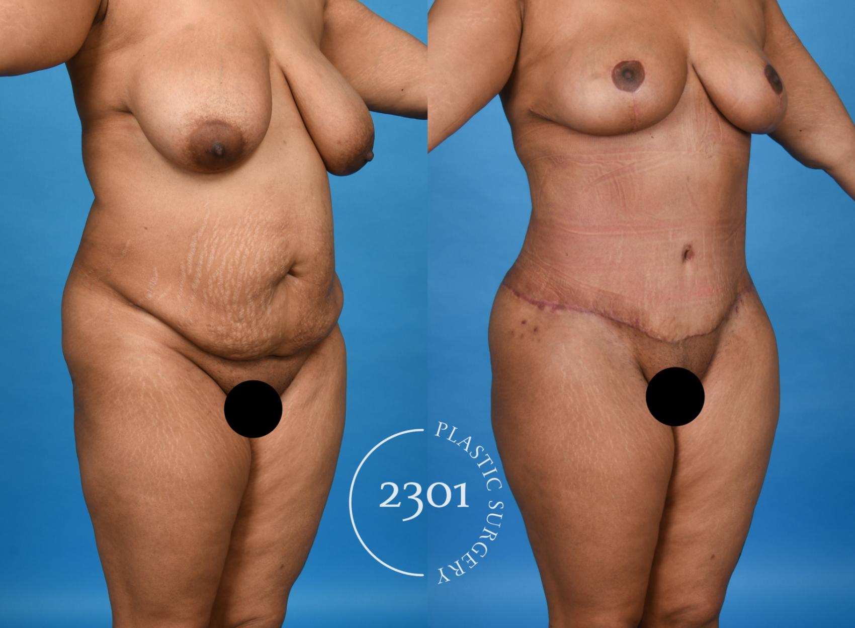 Before & After Mommy Makeover Case 758 Right Oblique View in Fort Worth, Plano, & Frisco, Texas