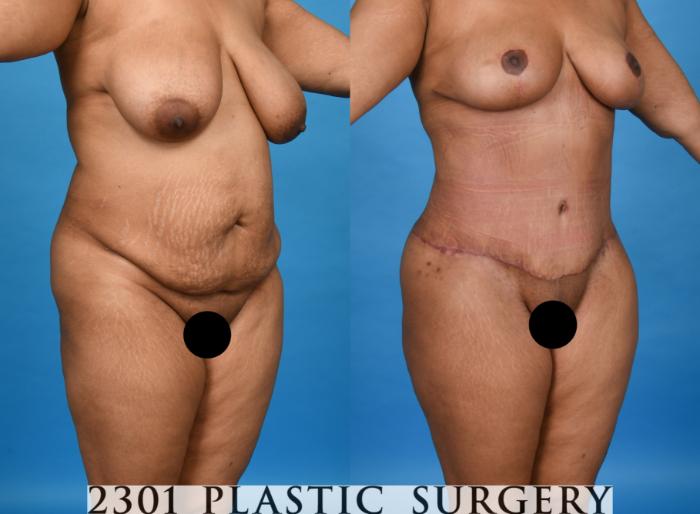Before & After Liposuction Case 758 Right Oblique View in Fort Worth, Plano, & Frisco, Texas