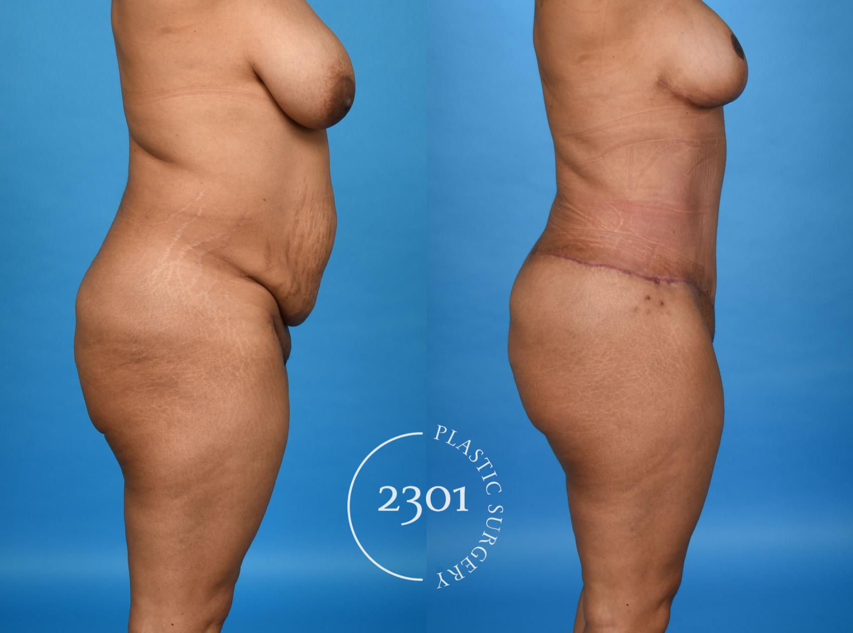 Before & After Mommy Makeover Case 758 Right Side View in Fort Worth, Plano, & Frisco, Texas