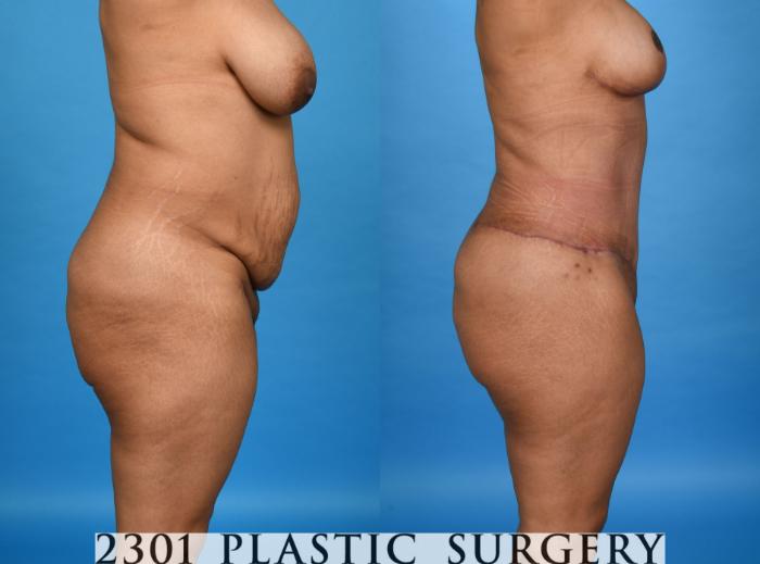 Before & After Tummy Tuck - Extended Case 758 Right Side View in Fort Worth, Plano, & Frisco, Texas