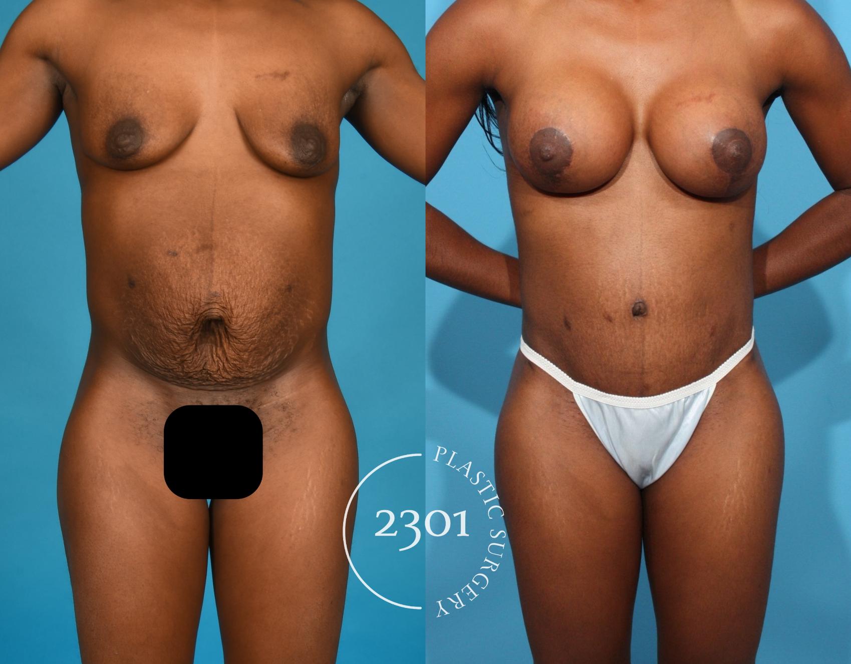 Before & After Tummy Tuck Case 761 Front View in Fort Worth, Plano, & Frisco, Texas