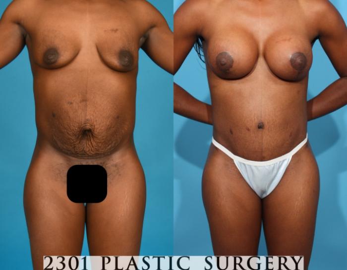 Before & After Breast Augmentation Case 761 Front View in Fort Worth, Plano, & Frisco, Texas