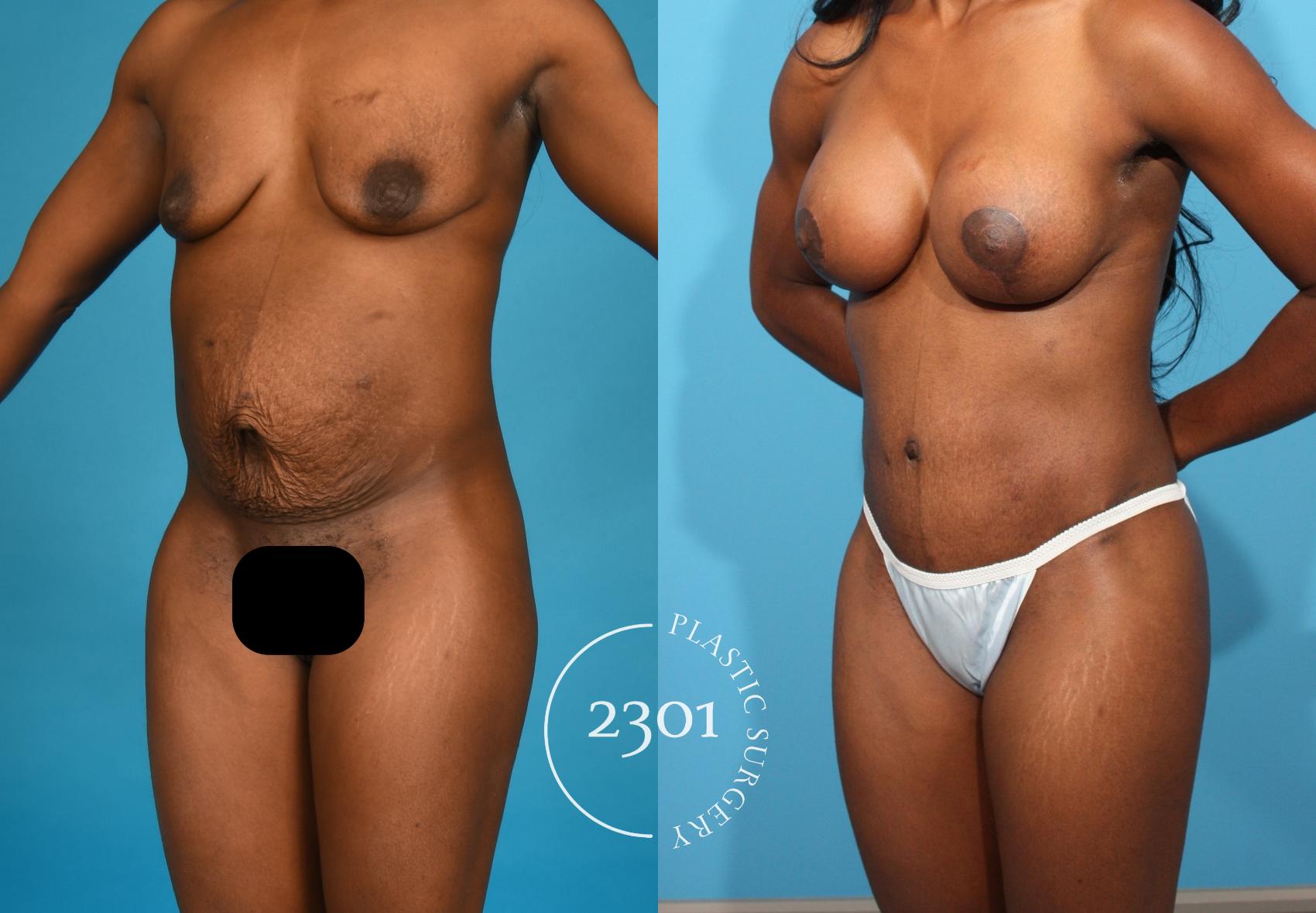 Before & After Mommy Makeover Case 761 Left Oblique View in Fort Worth, Plano, & Frisco, Texas