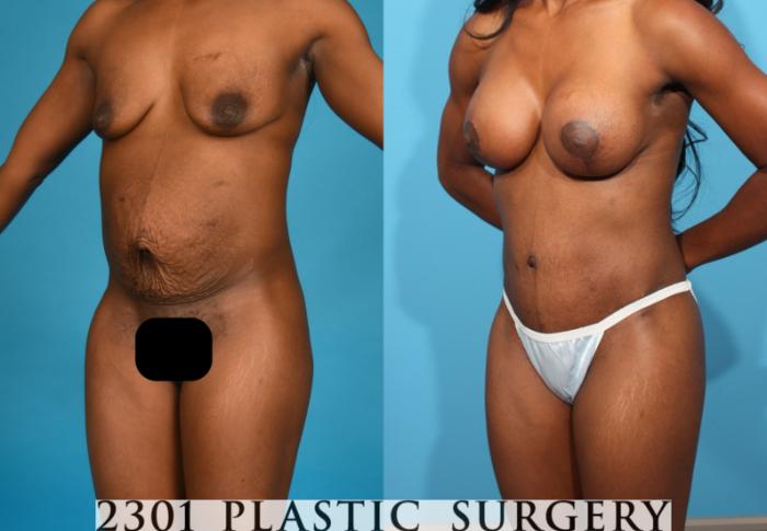 Before & After Breast Augmentation Case 761 Left Oblique View in Fort Worth, Plano, & Frisco, Texas