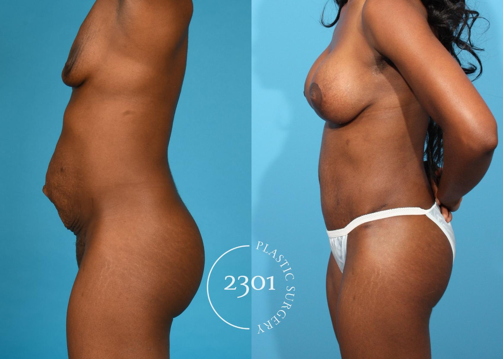 Before & After Mommy Makeover Case 761 Left Side View in Fort Worth, Plano, & Frisco, Texas