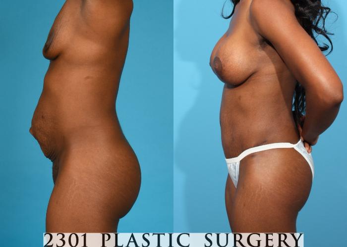 Before & After Breast Augmentation Case 761 Left Side View in Fort Worth, Plano, & Frisco, Texas