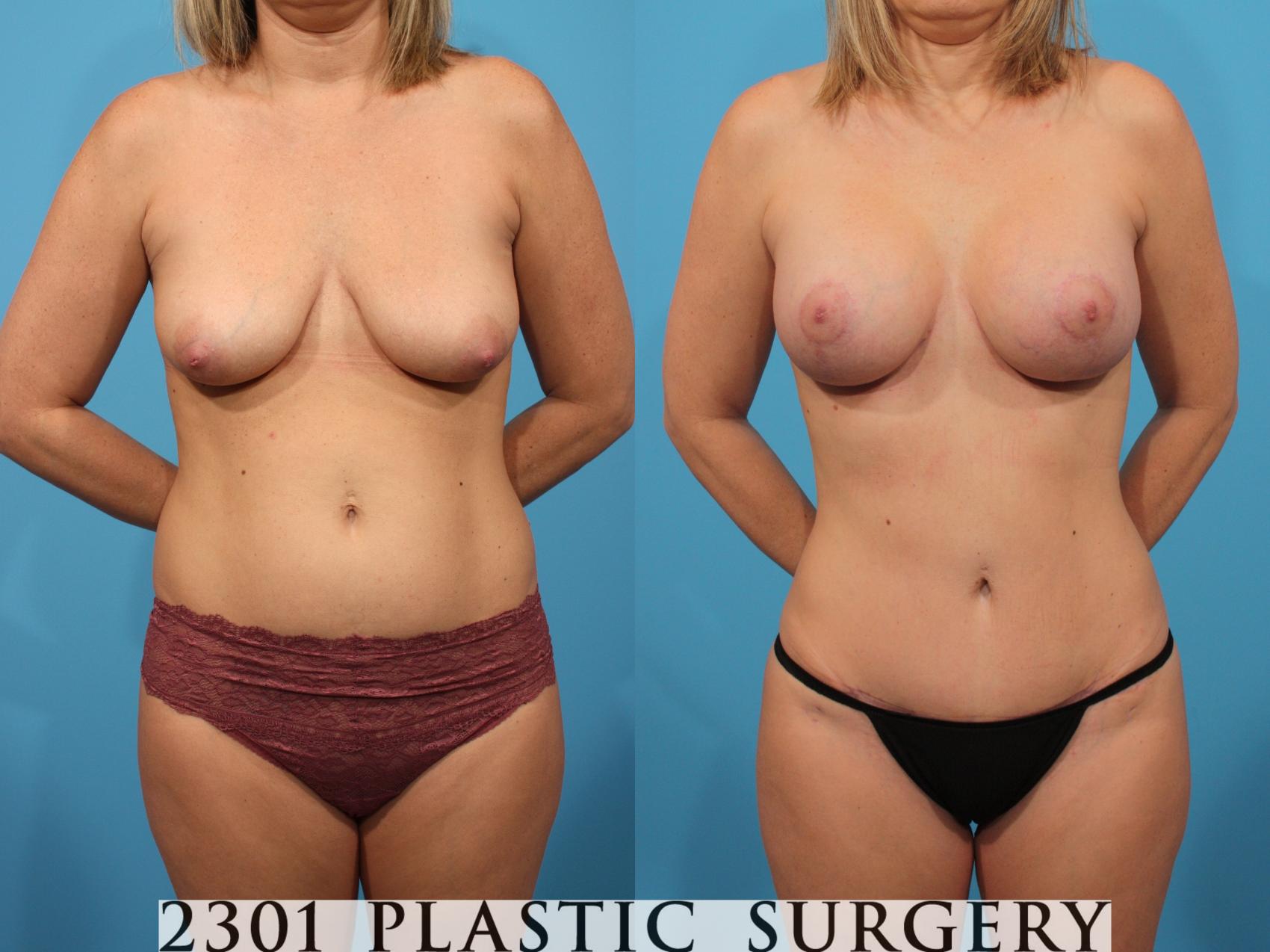 Before & After Tummy Tuck - Mini Case 765 Front View in Fort Worth, Plano, & Frisco, Texas