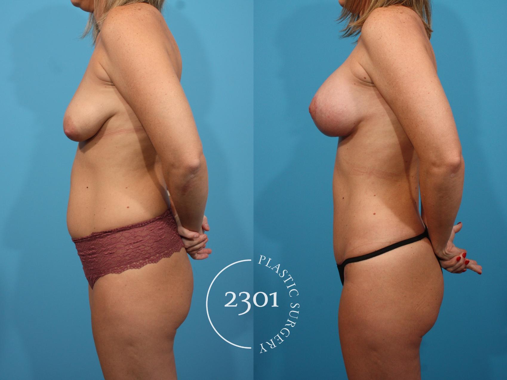 Before & After Mommy Makeover Case 765 Left Side View in Fort Worth, Plano, & Frisco, Texas