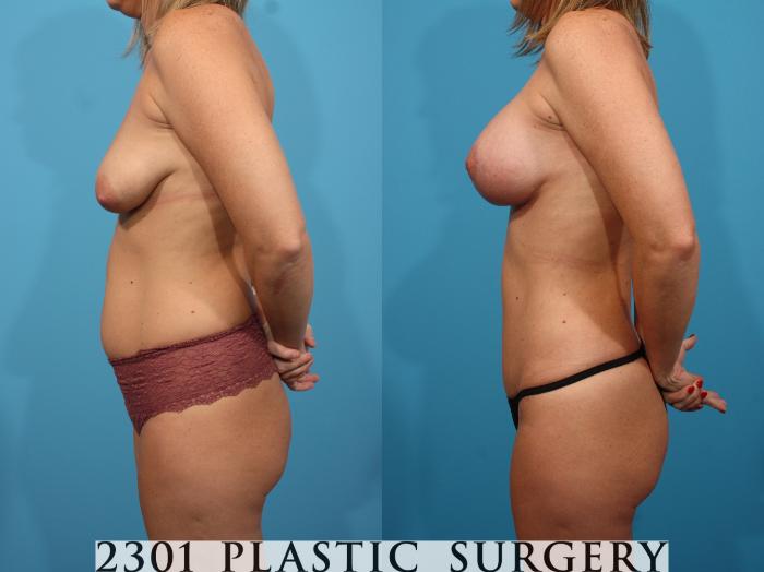 Before & After Mommy Makeover Case 765 Left Side View in Fort Worth & Frisco, Texas