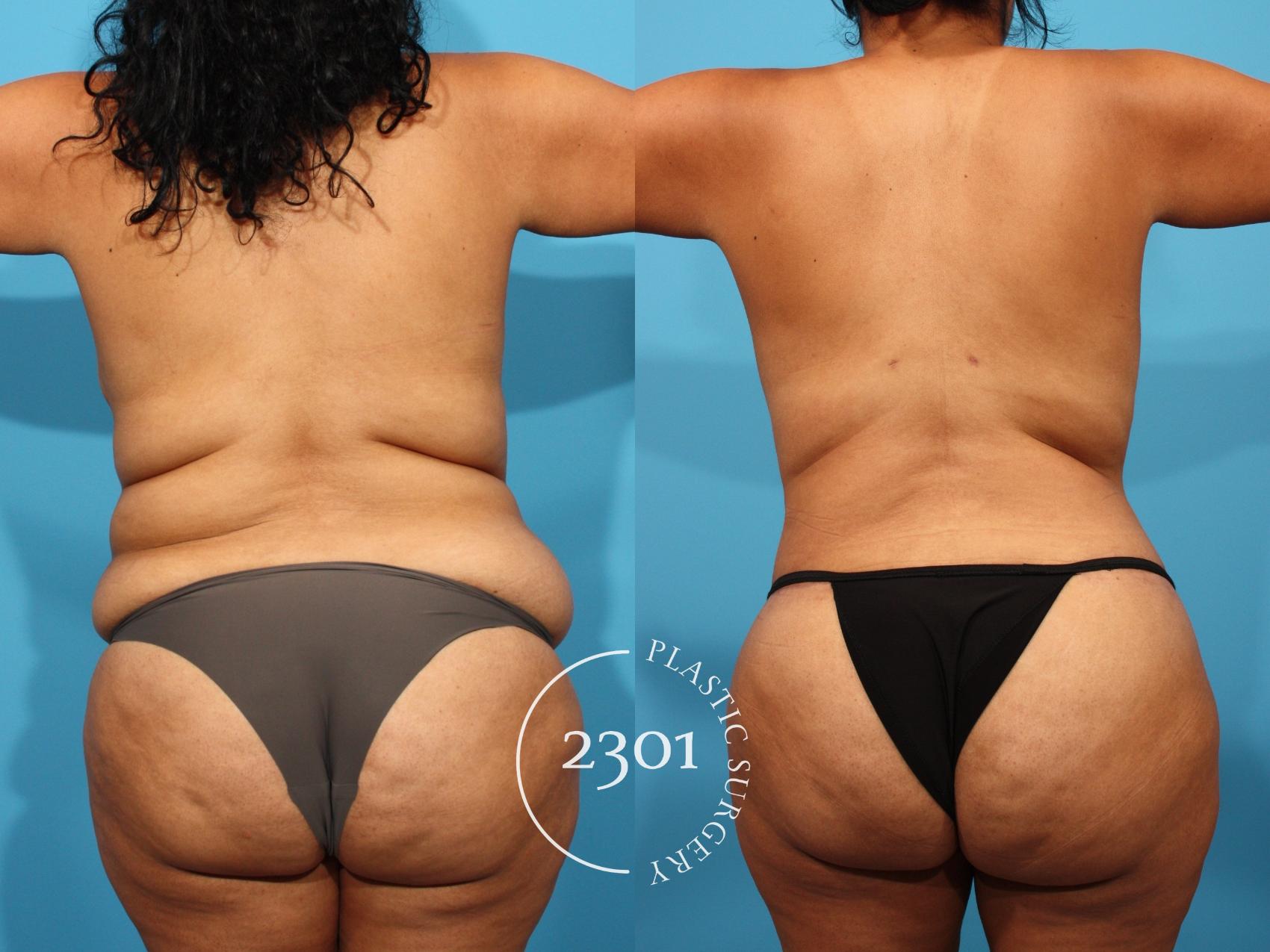 Before & After Mommy Makeover Case 776 Back View in Fort Worth, Plano, & Frisco, Texas