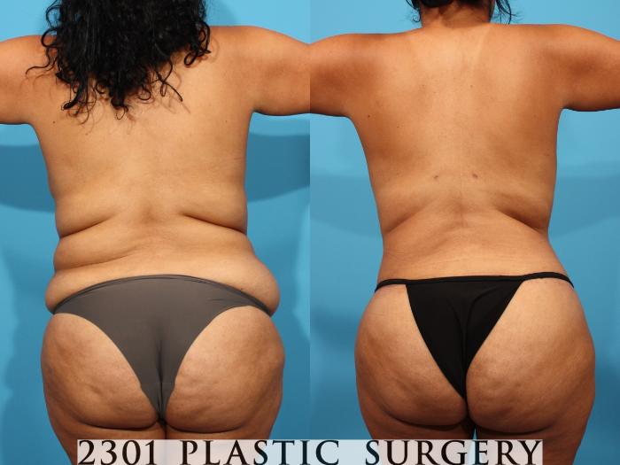 Before & After Tummy Tuck Case 776 Back View in Fort Worth, Plano, & Frisco, Texas