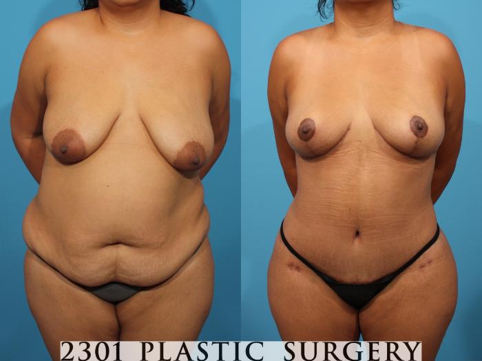 Before & After Liposuction Case 776 Front View in Fort Worth, Plano, & Frisco, Texas