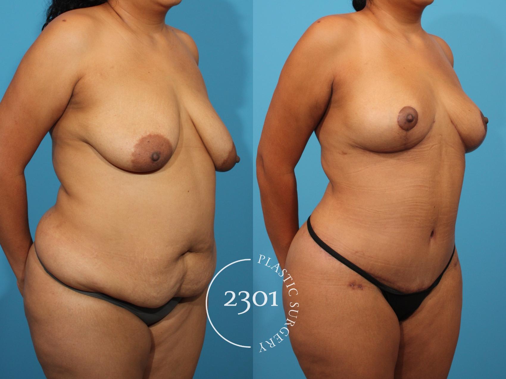 Before & After Mommy Makeover Case 776 Right Oblique View in Fort Worth, Plano, & Frisco, Texas