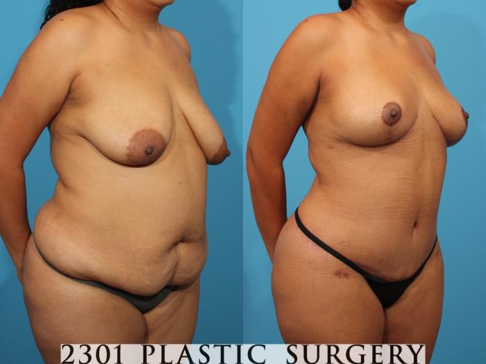 Before & After Tummy Tuck Case 776 Right Oblique View in Fort Worth, Plano, & Frisco, Texas