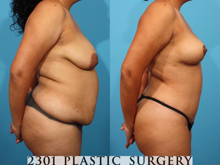 Before & After Breast Reduction Case 776 Right Side View in Fort Worth, Plano, & Frisco, Texas