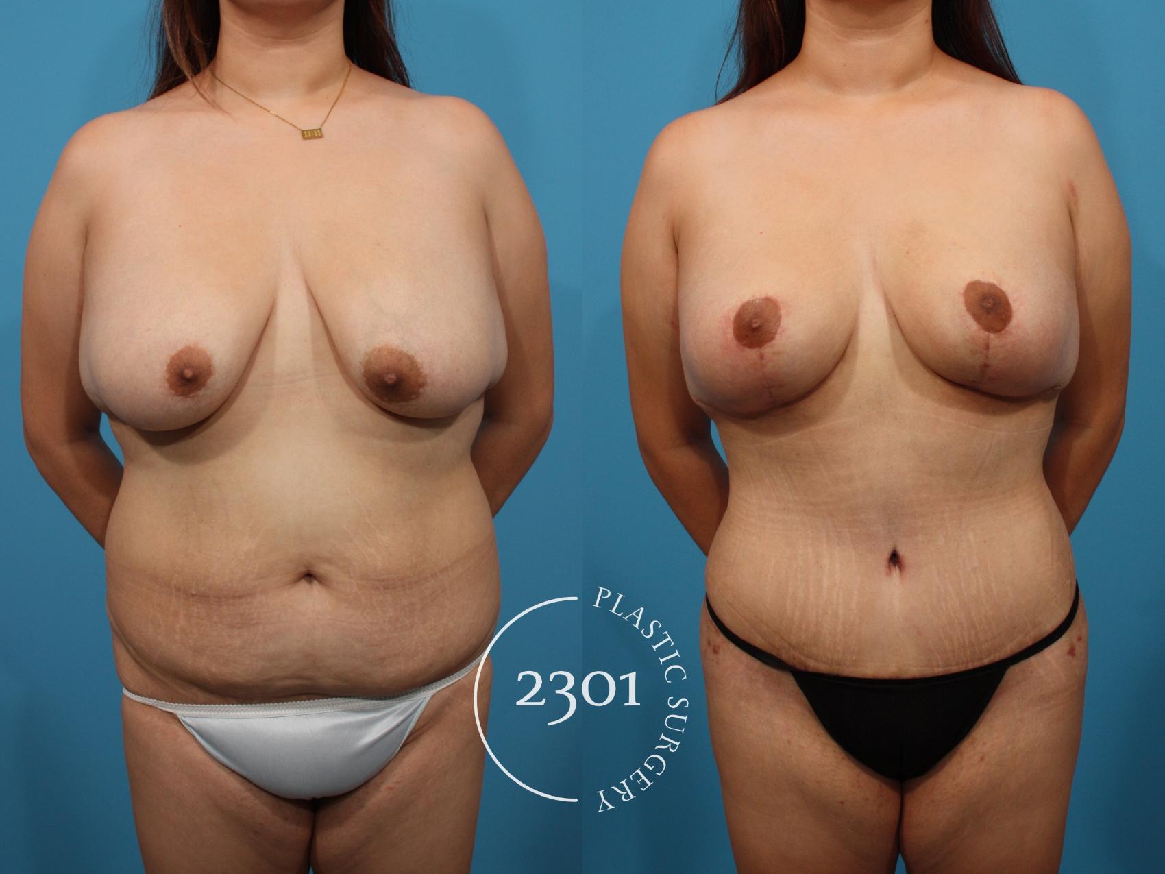 Before & After Mommy Makeover Case 788 Front View in Fort Worth, Plano, & Frisco, Texas