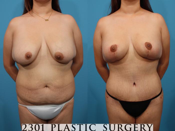 Before & After Mommy Makeover Case 788 Front View in Fort Worth, Plano, & Frisco, Texas