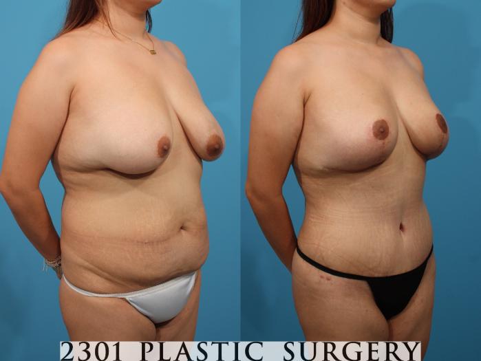 Before & After Mommy Makeover Case 788 Right Oblique View in Fort Worth, Plano, & Frisco, Texas