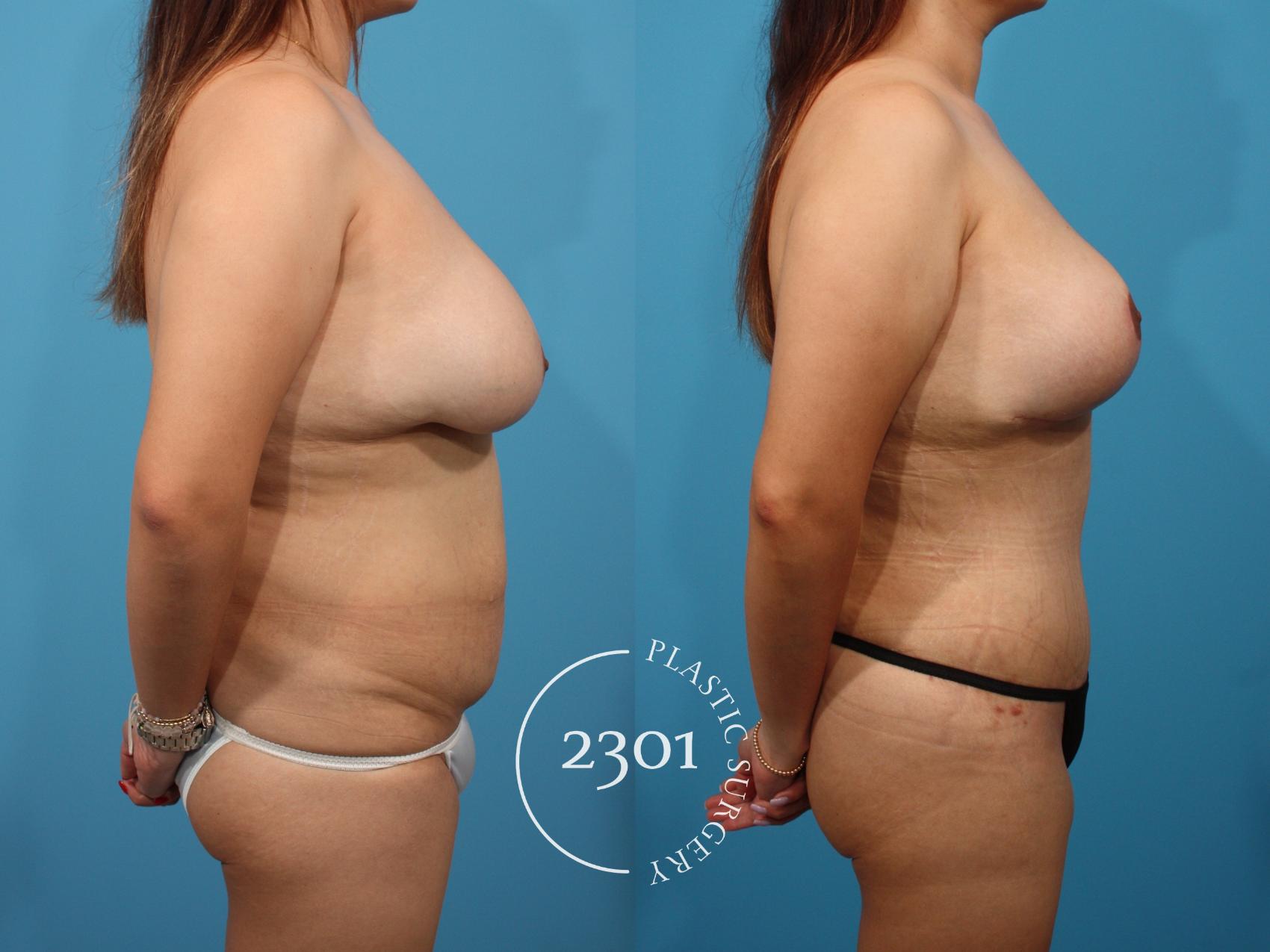Before & After Mommy Makeover Case 788 Right Side View in Fort Worth, Plano, & Frisco, Texas