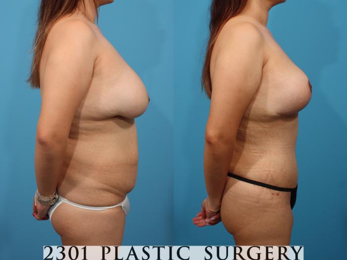 Before & After Mommy Makeover Case 788 Right Side View in Fort Worth, Plano, & Frisco, Texas