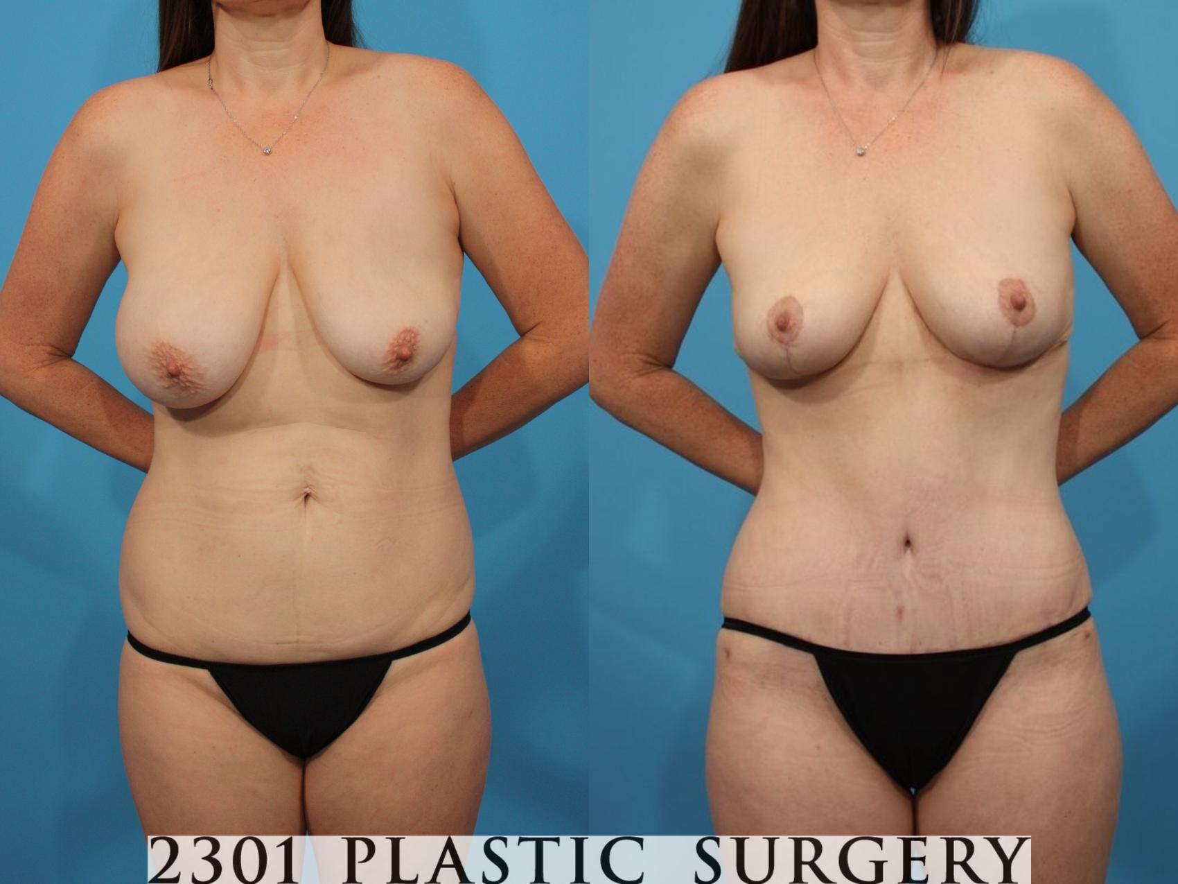 Before & After Mommy Makeover Case 790 Front View in Fort Worth, Plano, & Frisco, Texas