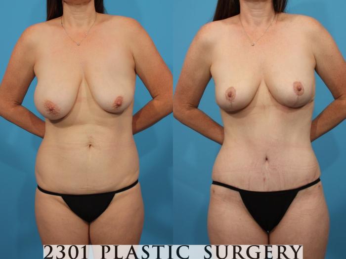 Before & After Breast Lift (Mastopexy) Case 790 Front View in Fort Worth, Plano, & Frisco, Texas
