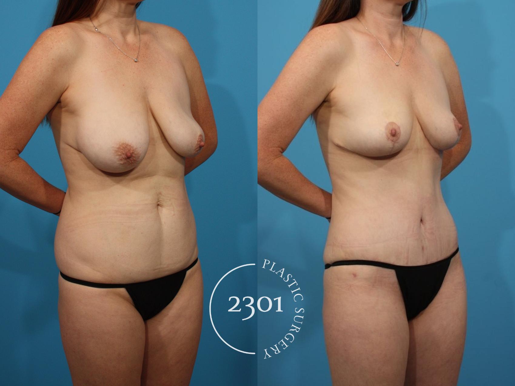 Before & After Mommy Makeover Case 790 Right Oblique View in Fort Worth, Plano, & Frisco, Texas