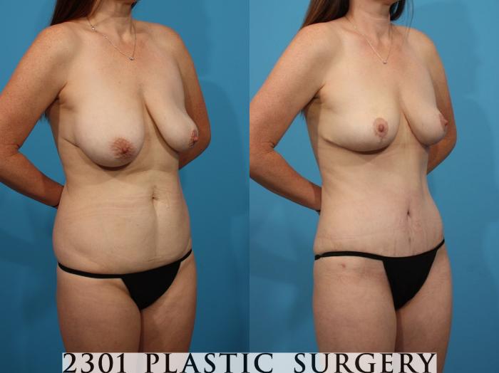 Before & After Mommy Makeover Case 790 Right Oblique View in Fort Worth, Plano, & Frisco, Texas