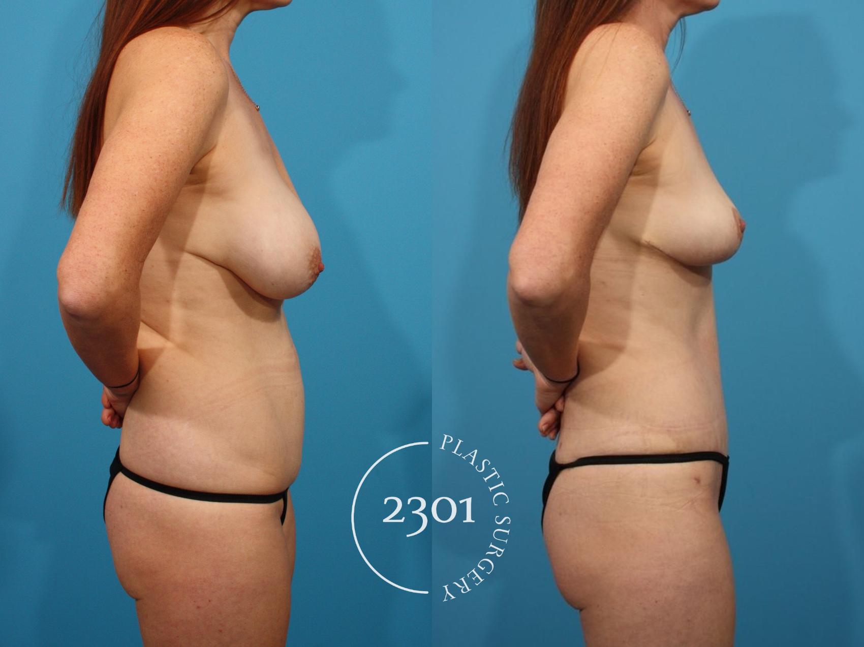 Before & After Mommy Makeover Case 790 Right Side View in Fort Worth, Plano, & Frisco, Texas