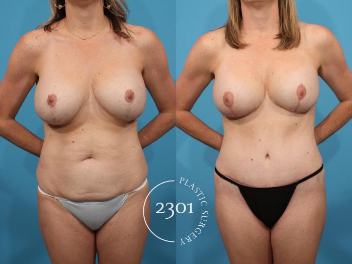 Before & After Mastopexy & Augmentation Case 791 Front View in Fort Worth, Plano, & Frisco, Texas