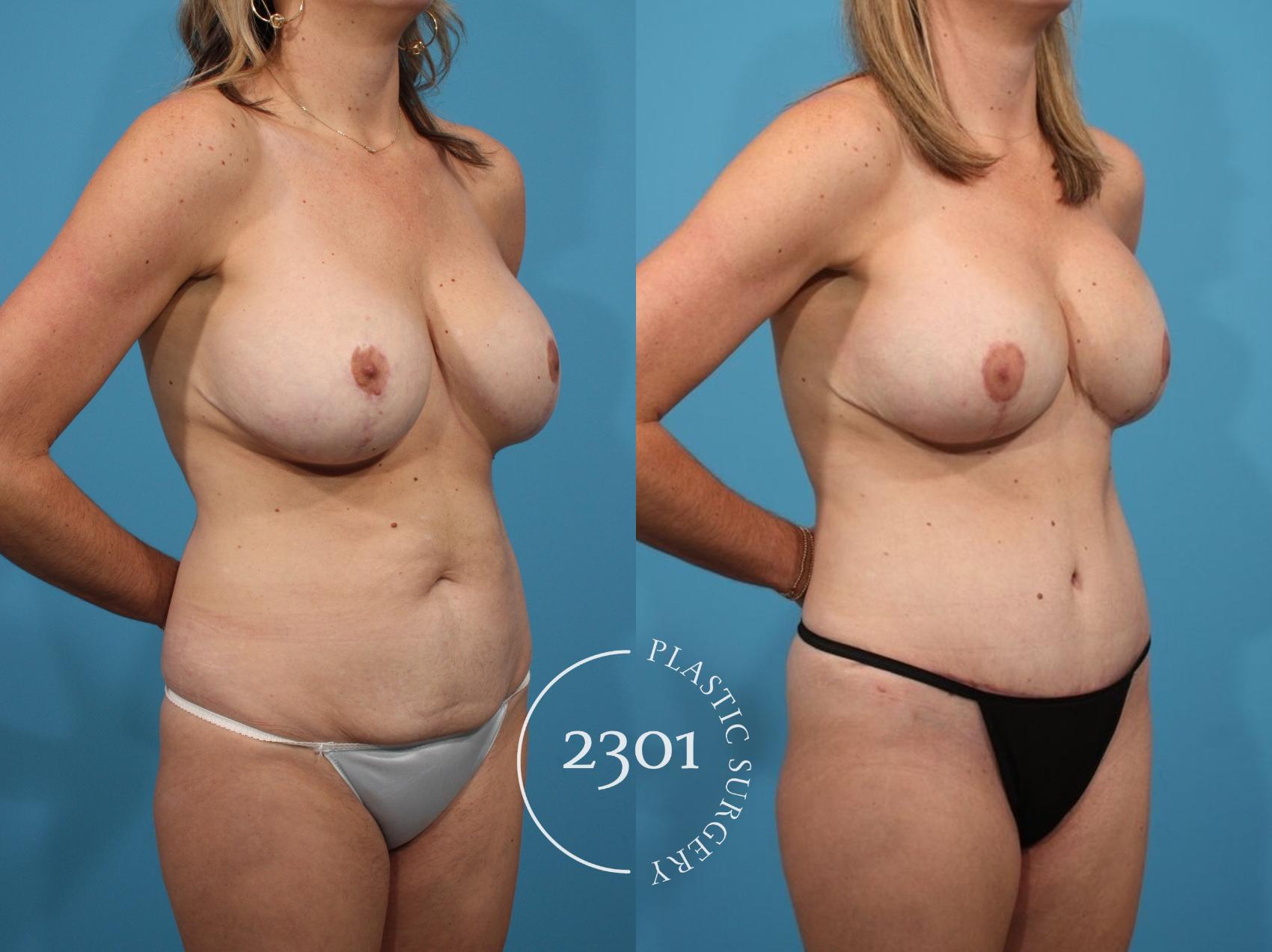 Before & After Breast Lift (Mastopexy) Case 791 Right Oblique View in Fort Worth, Plano, & Frisco, Texas