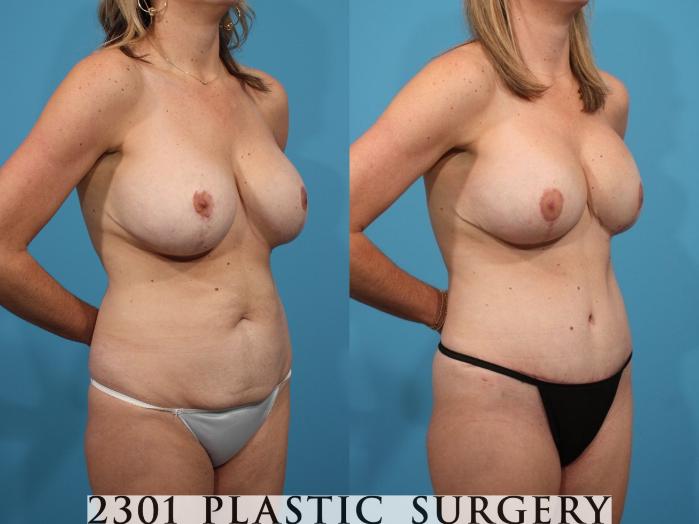 Before & After Mommy Makeover Case 791 Right Oblique View in Fort Worth, Plano, & Frisco, Texas