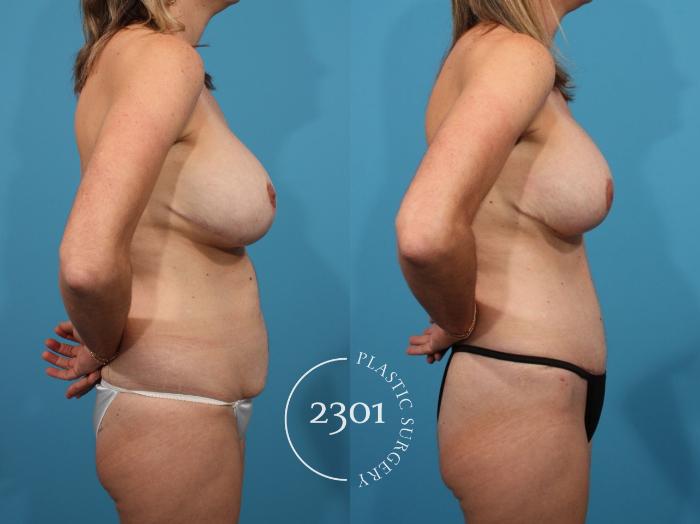 Before & After Breast Lift (Mastopexy) Case 791 Right Side View in Fort Worth, Plano, & Frisco, Texas