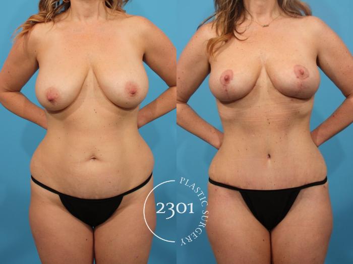 Before & After Breast Lift (Mastopexy) Case 810 Front View in Fort Worth, Plano, & Frisco, Texas