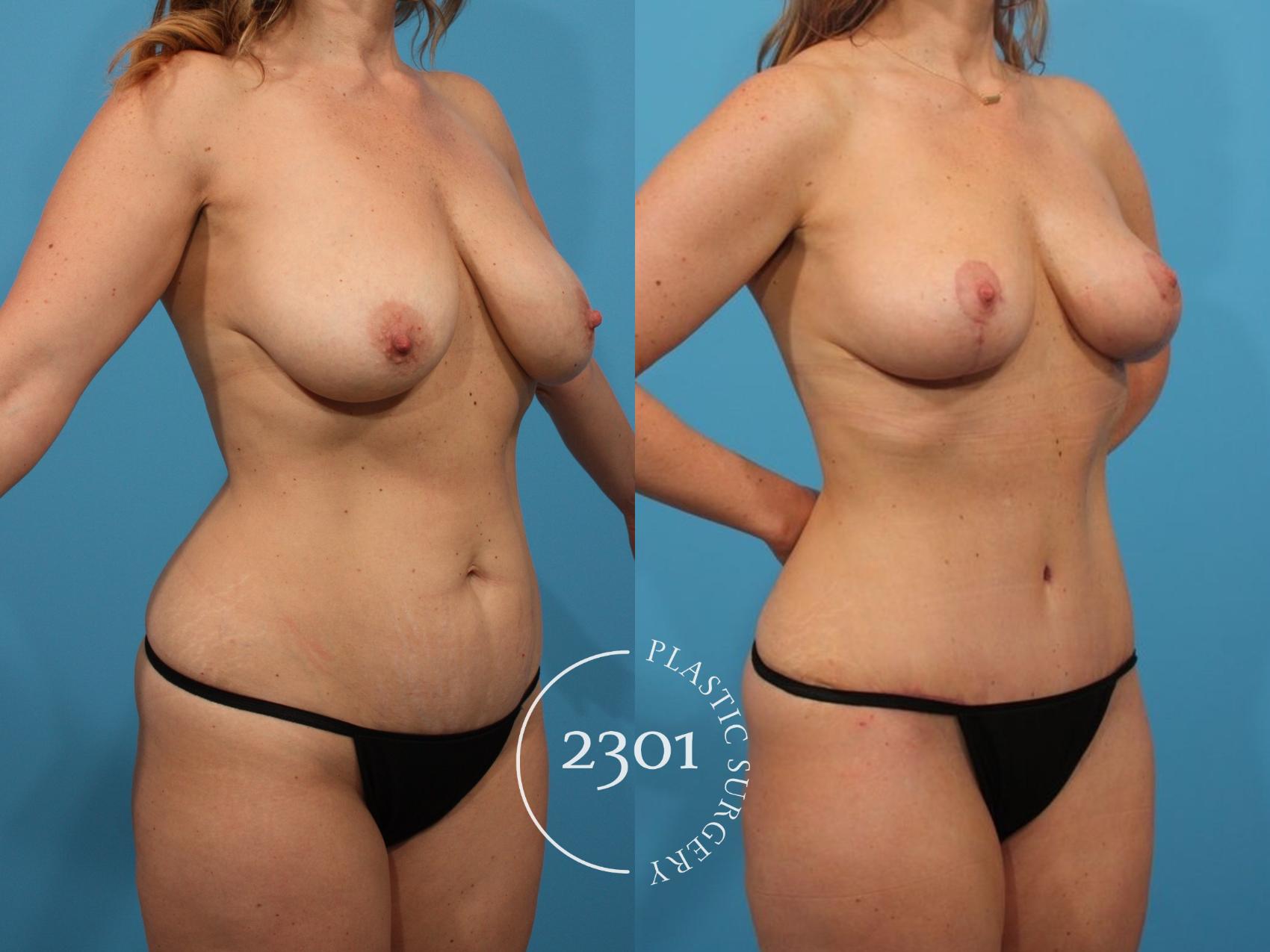 Before & After Tummy Tuck Case 810 Right Oblique View in Fort Worth, Plano, & Frisco, Texas