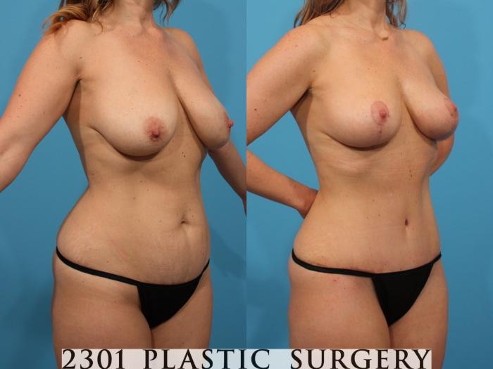 Before & After Mommy Makeover Case 810 Right Oblique View in Fort Worth, Plano, & Frisco, Texas