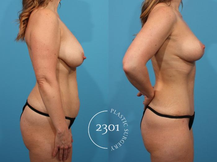 Before & After Tummy Tuck Case 810 Right Side View in Fort Worth, Plano, & Frisco, Texas