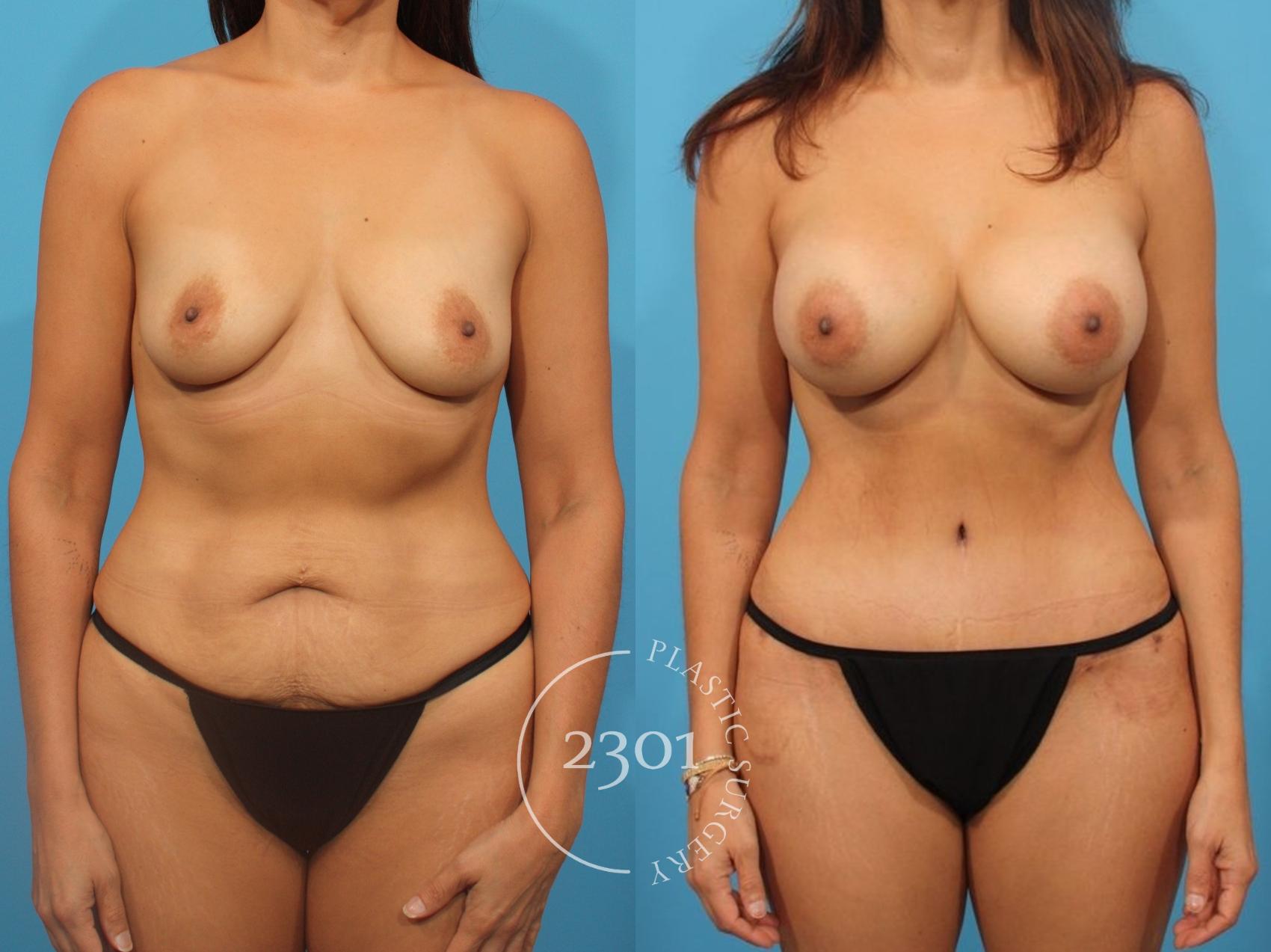 Before & After Tummy Tuck Case 828 Front View in Fort Worth, Plano, & Frisco, Texas